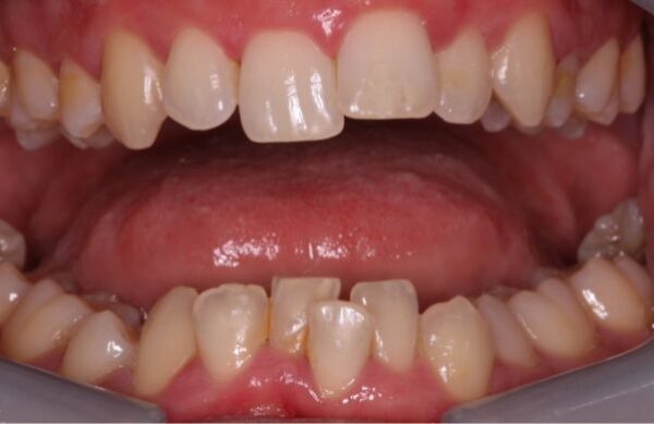 Before - Staly  Dental