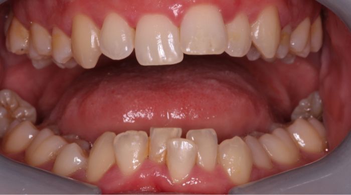 Before - Staly  Dental