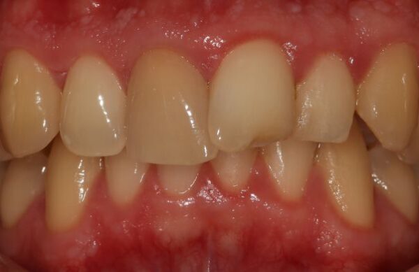 Before - Staly  Dental