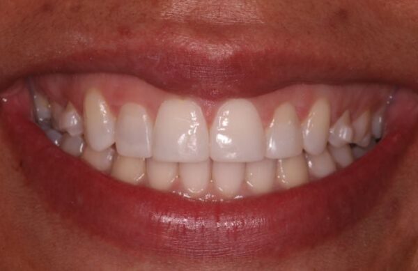 After - Staly Dental