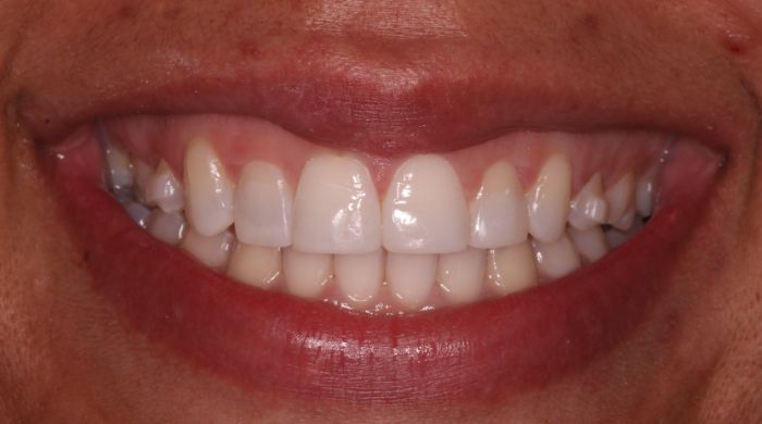 After - Staly Dental