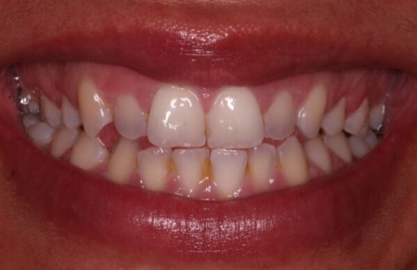 Before - Staly  Dental