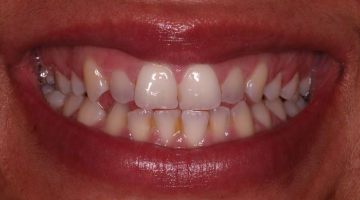 Before - Staly  Dental