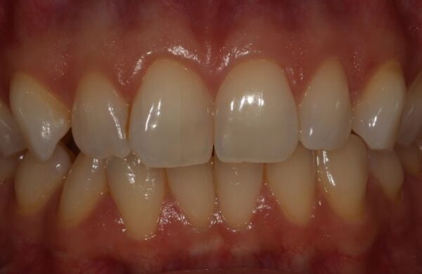 Before - Staly  Dental