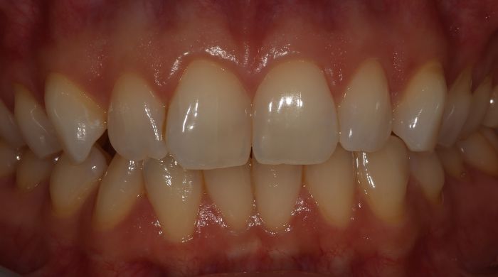 Before - Staly  Dental