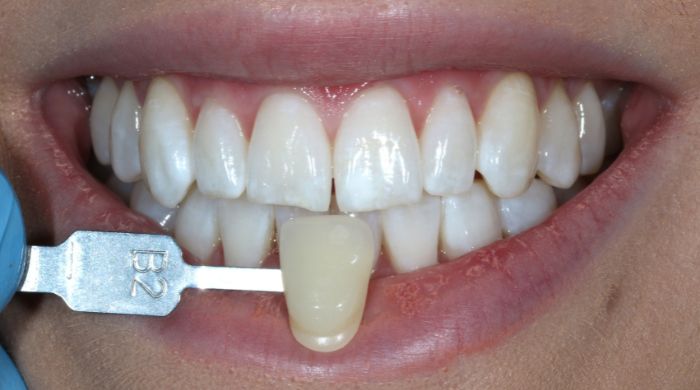 After - Staly Dental