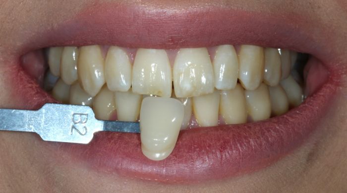 Before - Staly  Dental