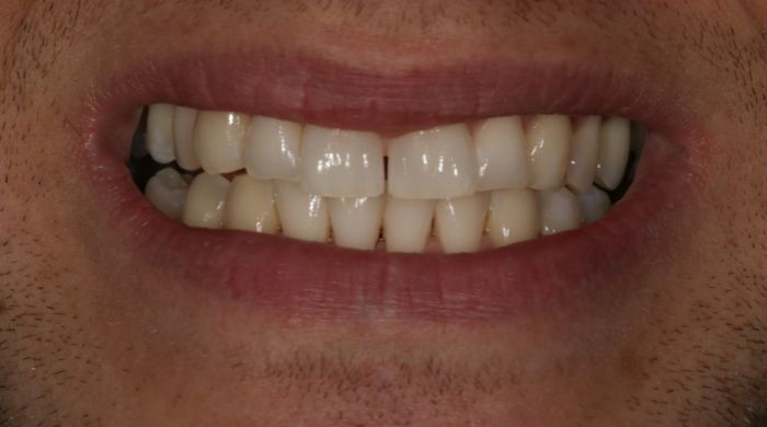 After - Staly Dental