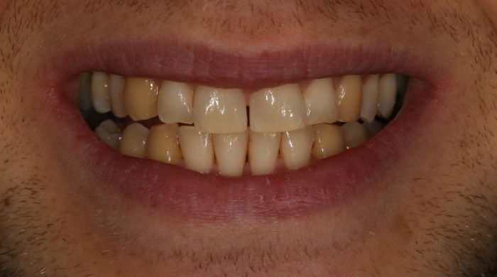 Before - Staly  Dental