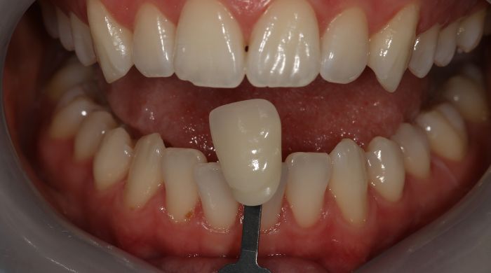 After - Staly Dental