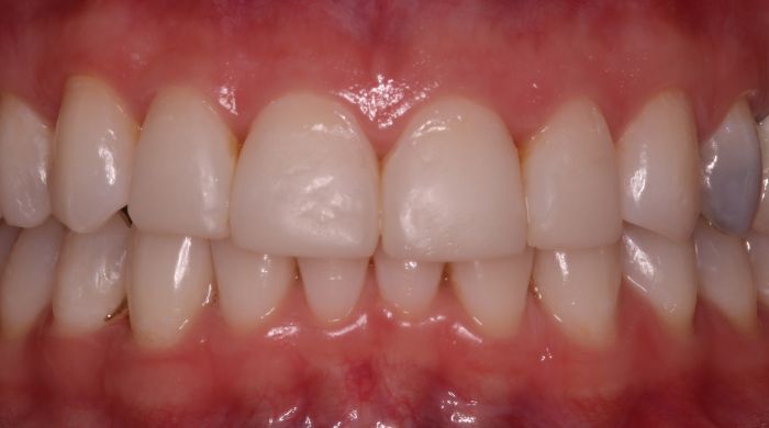 After - Staly Dental