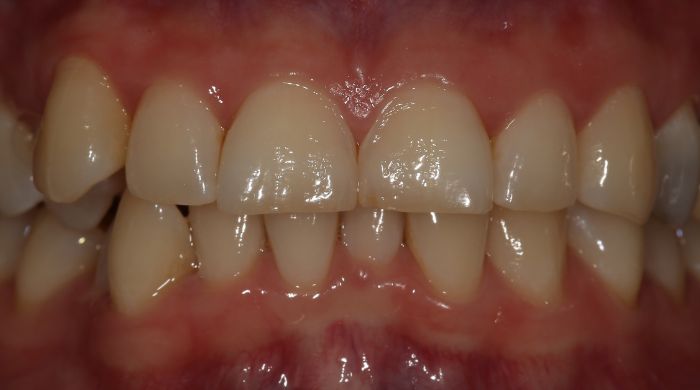 Before - Staly  Dental