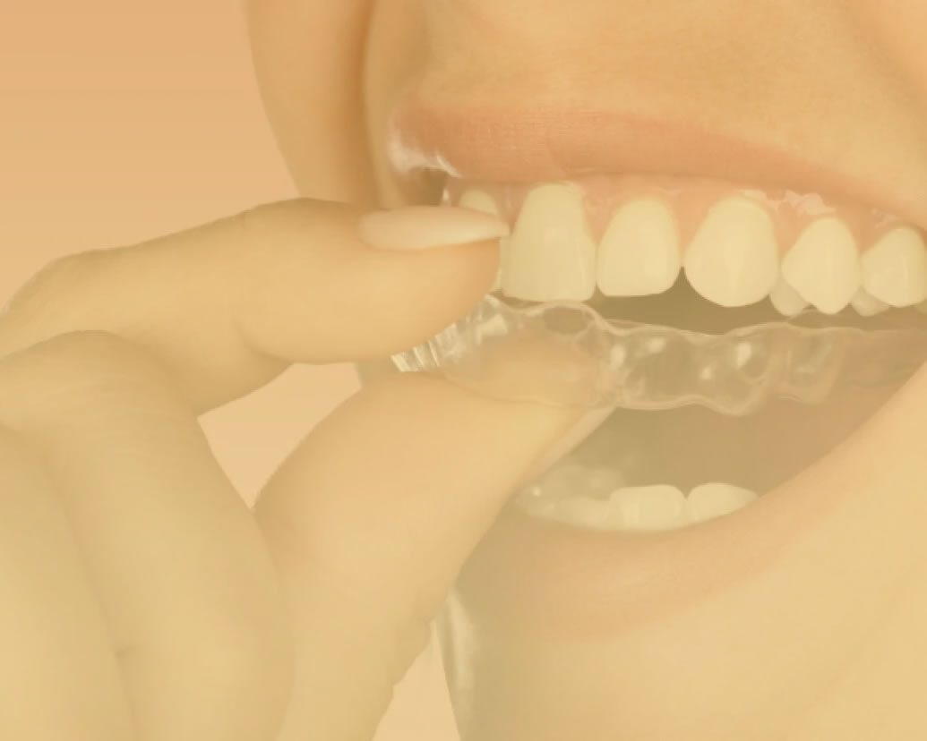 invisalign_image