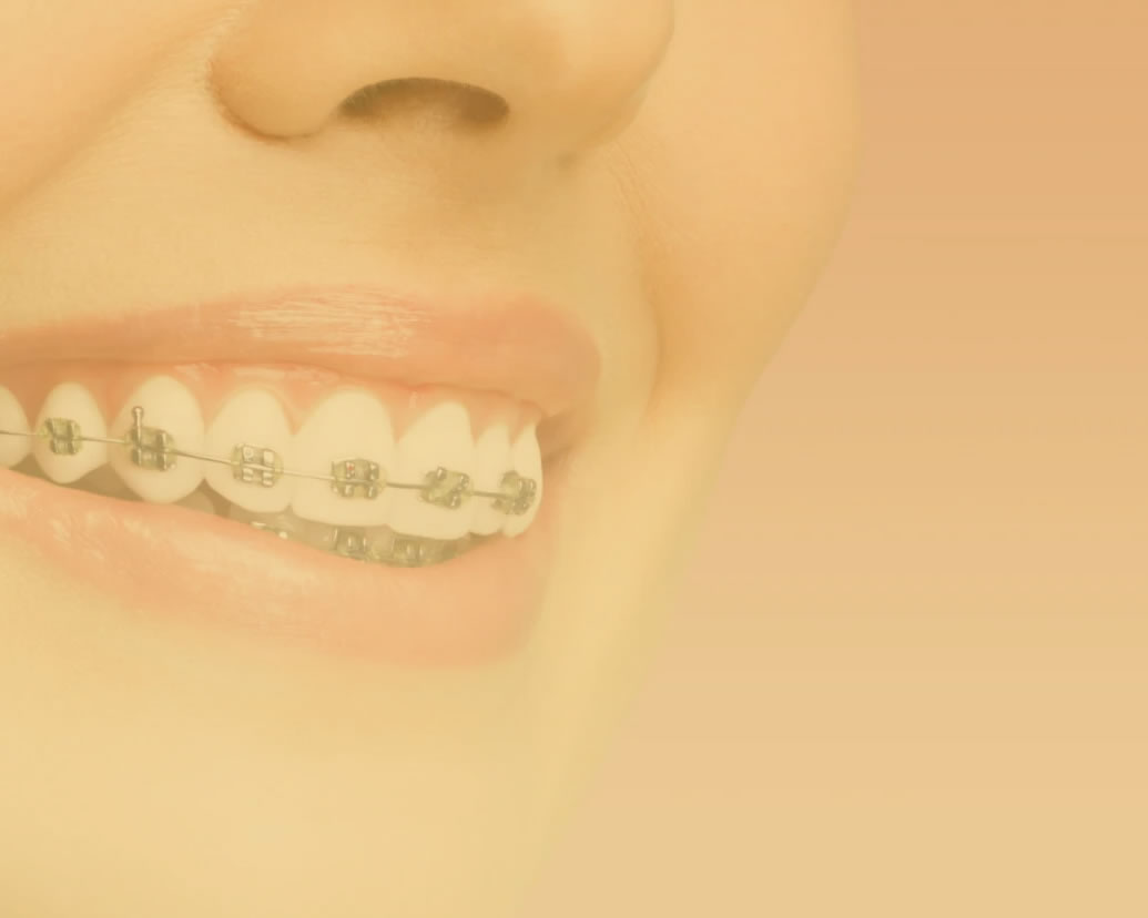  invisalign_image